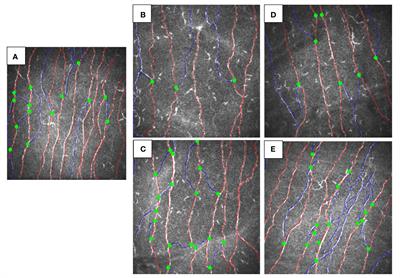 Case report: Nerve fiber regeneration in children with melanocortin 4 receptor gene mutation related obesity treated with semaglutide